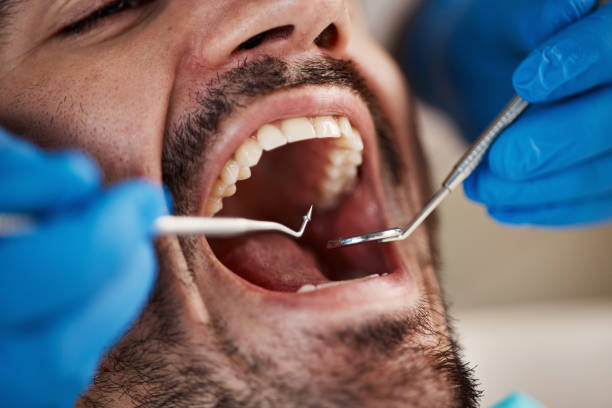 Best Emergency Dental Care for Broken or Chipped Teeth in Nipomo, CA
