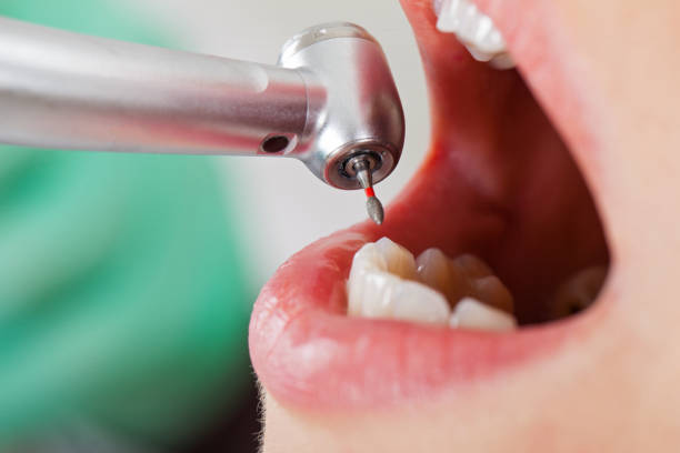 Best Emergency Denture Repair in Nipomo, CA